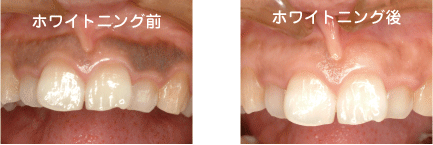 ホワイトニング治療