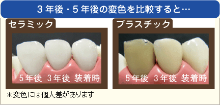 3年後・5年後の変色を比較すると