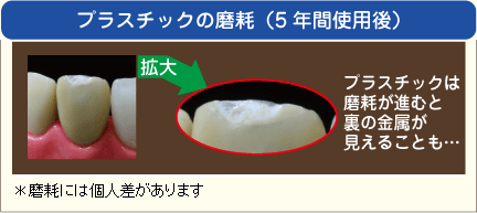 プラスチックの摩耗