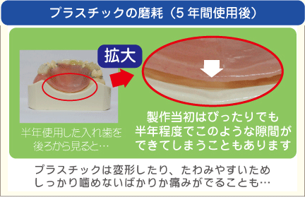 プラスチックの摩耗